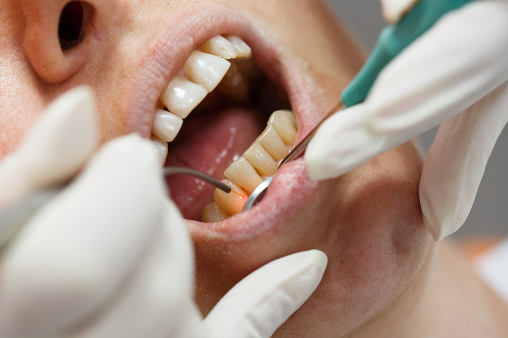 Laser Dentistry
