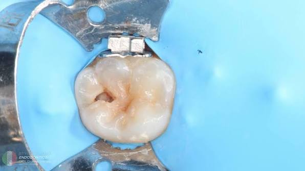 Microscopic Root Canal